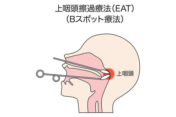上咽頭擦過療法（EAT・Bスポット）